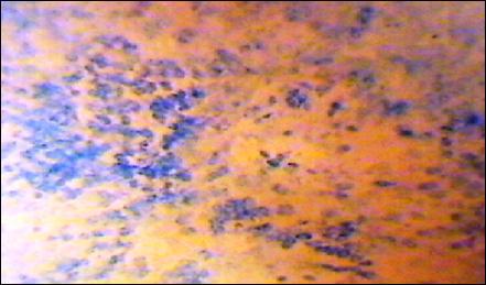Микроэндоскопическая картина при хроническом атрофическом рините